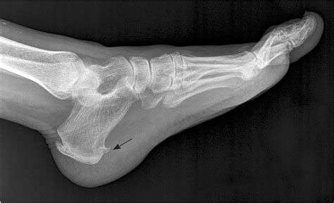 Does Plantar Fasciitis Show Up on X-ray? Exploring the Invisible Threads of Foot Pain